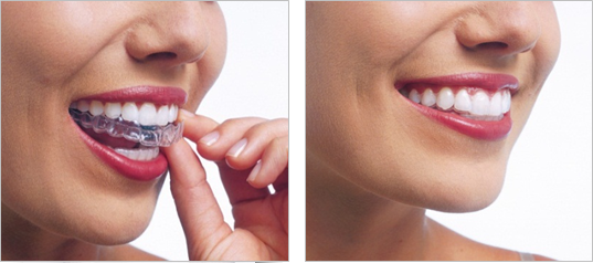 Invisalign fogszab lyoz Magyar Fogorvos Londonban